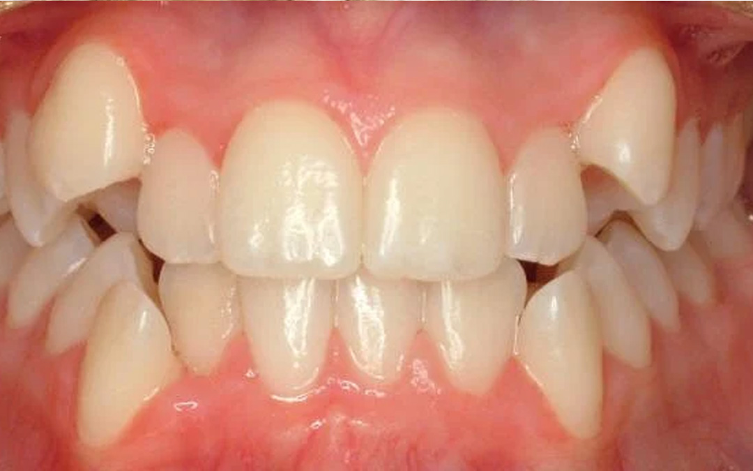 Sovraffollamento Dentario