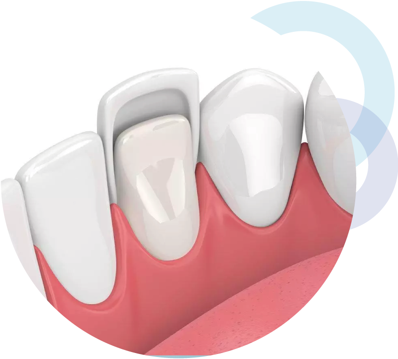 Faccette dentali Taranto